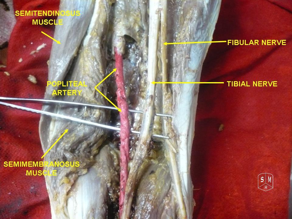 Popliteal fossa dissection: tibial and common fibular nerves shown separated, with the popliteal artery medial, bounded by semitendinosus and semimembranosus.