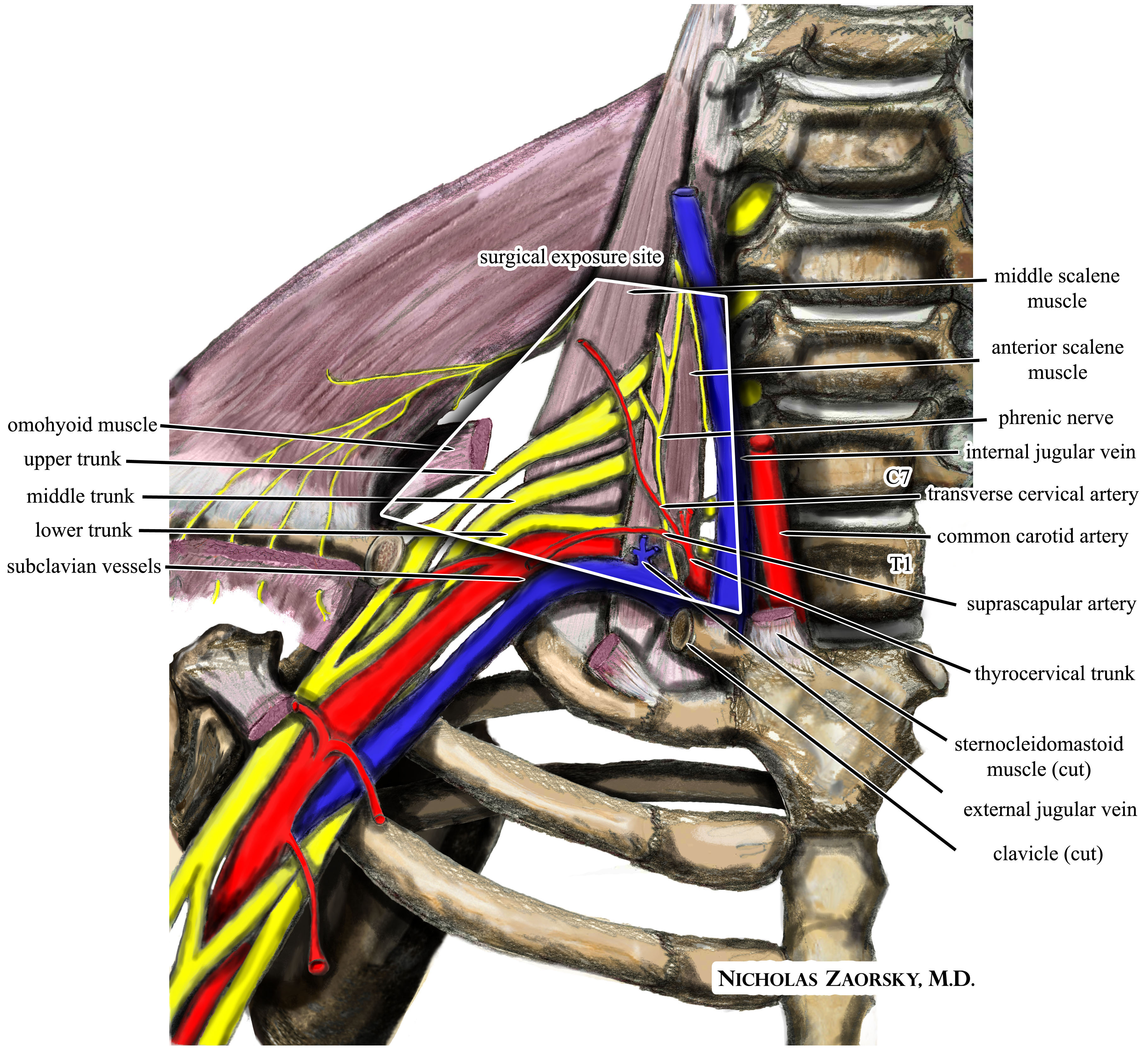 An anterior view of the right scalene triangle with the clavicle and sternocleidomastoid cut, showing the upper, middle and lower trunks of the brachial plexus emerging between the anterior and middle scalene muscles, the phrenic nerve descending on the face of the anterior scalene, and the subclavian vessels crossing beneath — the white outline marks the surgical exposure window the illustration was drawn for, not a block target.